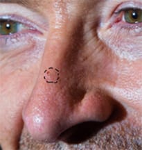 Likely Contour of Hugh Jackman's Basal Cell Carcinoma in 2014