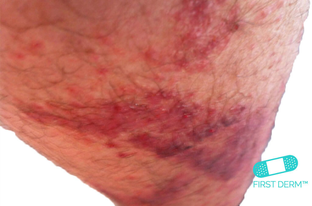 Red spots on skin CONTACT DERMATITIS CAUSED BY PLANTS on leg ICD 10 L25.5