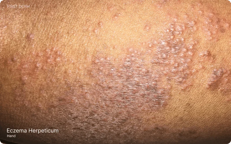 Flared eczema patches on skin infected by herpes simplex virus, showcasing eczema herpeticum