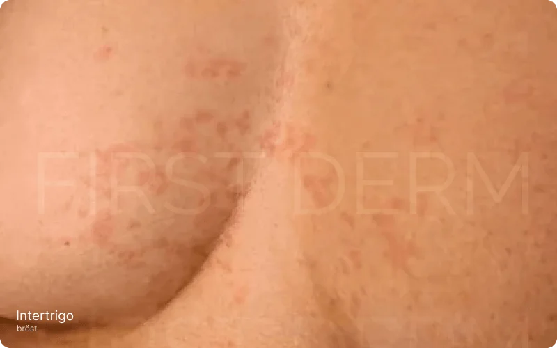 Intertrigo under bröstet med symtom som rodnad, irritation, och hudinflammation, visande fuktig, röd hud med sprickor och blåsor, typiska för hudvecksdermatit orsakad av friktion och fuktighet.