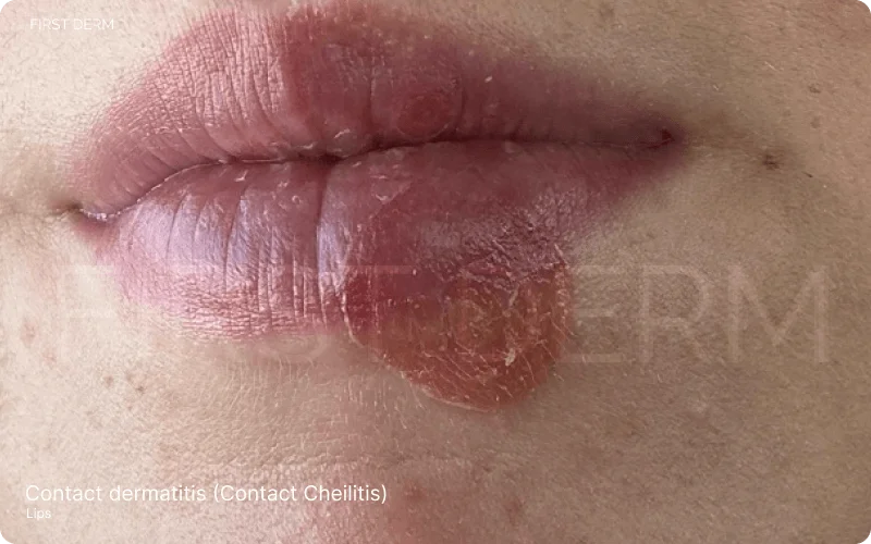 Image showing contact dermatitis - contact cheilitis on the lower lip, characterized by tiny blisters and a reddish patch, depicting the typical symptoms of this skin condition