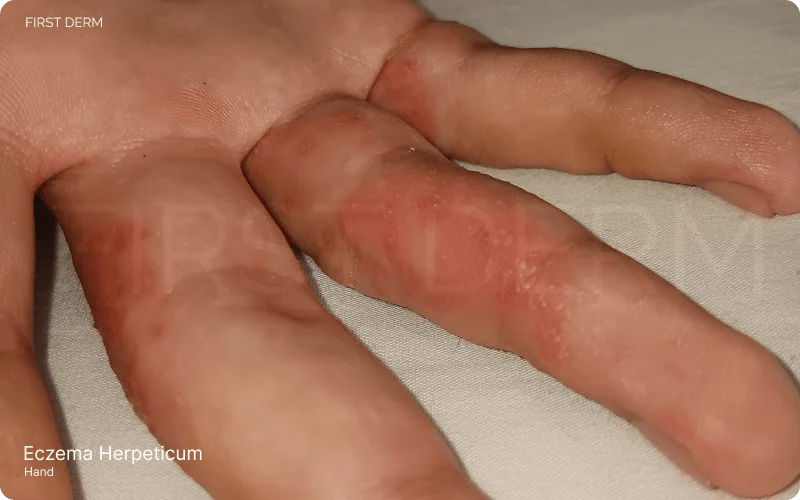 Cold sores and small blisters on top of hand eczema, showing eczema herpeticum on fingers with red inflamed skin