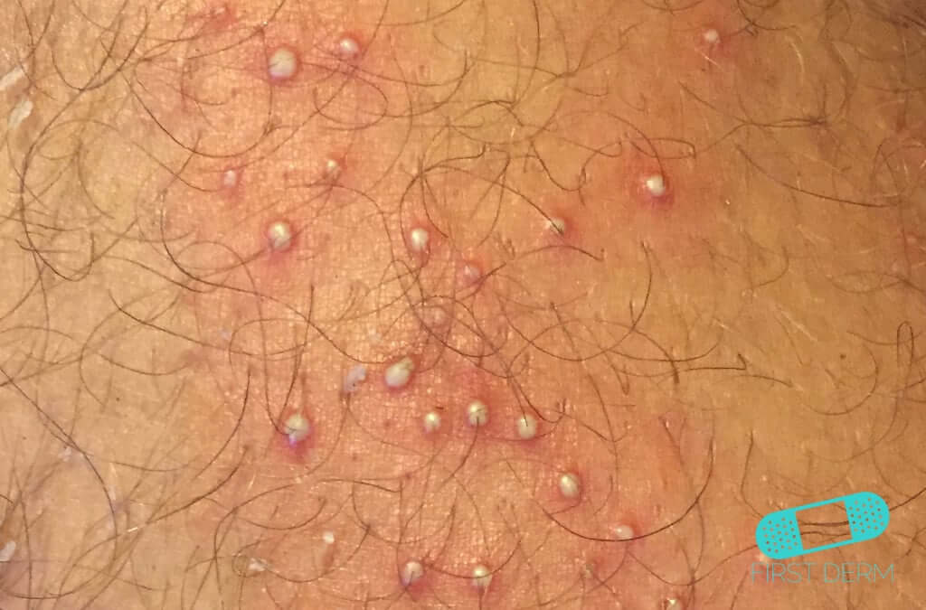 Wrestler rash: Folliculitis (Barber’s Itch) - Image illustrating a cluster of small bumps with a reddish base and white-tipped heads on a wrestler's thigh, showcasing the typical appearance of this skin condition in areas prone to friction and sweat.