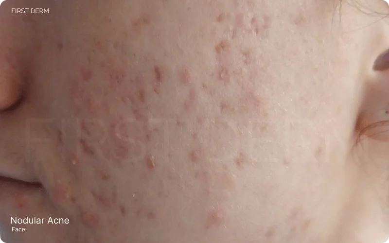 Nodular acne scarring, indicating previous acne lesions' healing and tissue damage