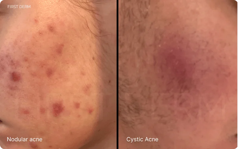 Comparison image showing two types of severe acne: On the left, nodular acne with red slightly raised spots (papules) and pus-filled spots (pustules); on the right, cystic acne characterized by a single, reddish, slightly raised cyst