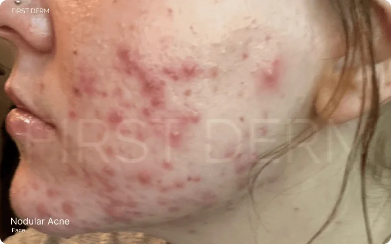 person's face showing symptoms of nodular acne, including red slightly raised spots (papules), pus-filled spots (pustules), and deeper inflamed cysts that may be painful