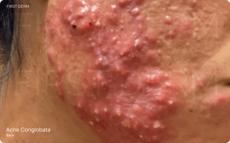 Severe acne conglobata with cystic nodules, abscesses, and sinus tracts creating a complex network of deep, inflamed lesions across the skin
