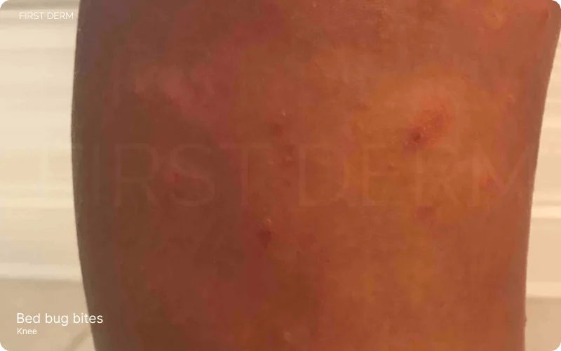 cluster of red, itchy spots from bed bug bites located below the knee, highlighting the typical appearance of bed bug reactions on the skin