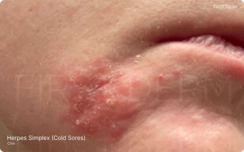 dry and scaly patch on the chin, indicative of a cold sore in its current state, with a history of the area initially being red and irritated, and a previous pimple, characteristic of herpes simplex virus infection