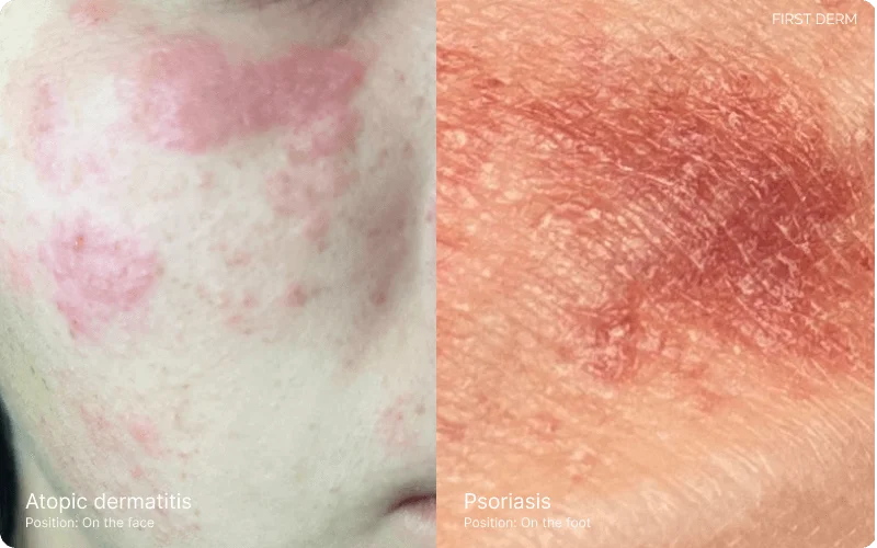 eczema and psoriasis compared
