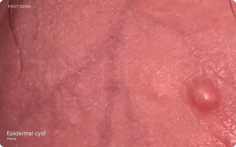 epidermal cyst on penis present as a tiny bump at the base of penile shaft