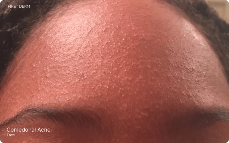 Image of forehead with comedonal acne, showing multiple small white bumps known as whiteheads, white due to trapped oil and skin cells beneath the skin's surface