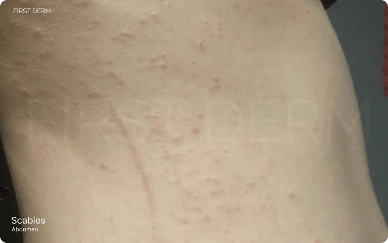 Close-up view of scabies on the abdomen, showcasing an itchy rash with clustered lesions and distinctive burrow patterns caused by mites