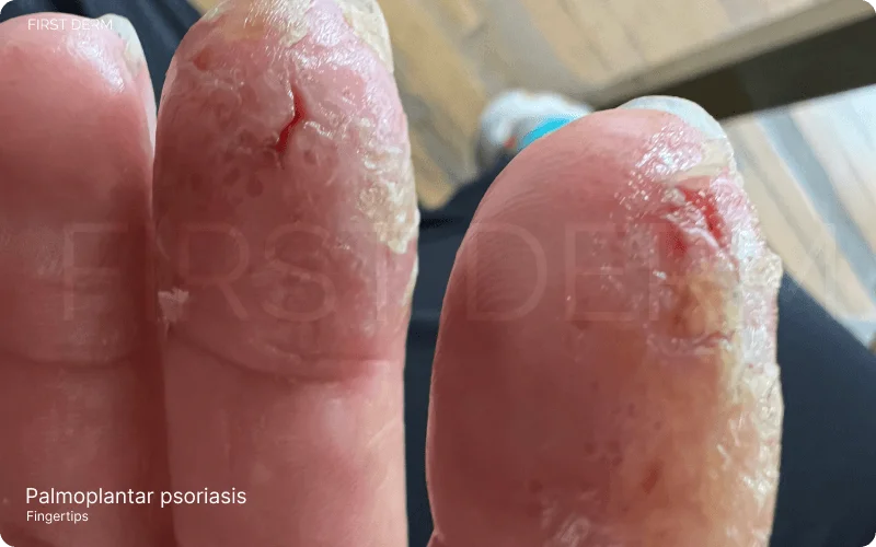 Cracked fingertips indicating early signs of palmoplantar psoriasis, showcasing red patches with white scales on hands and feet, similar to eczema but with unique deep fissures