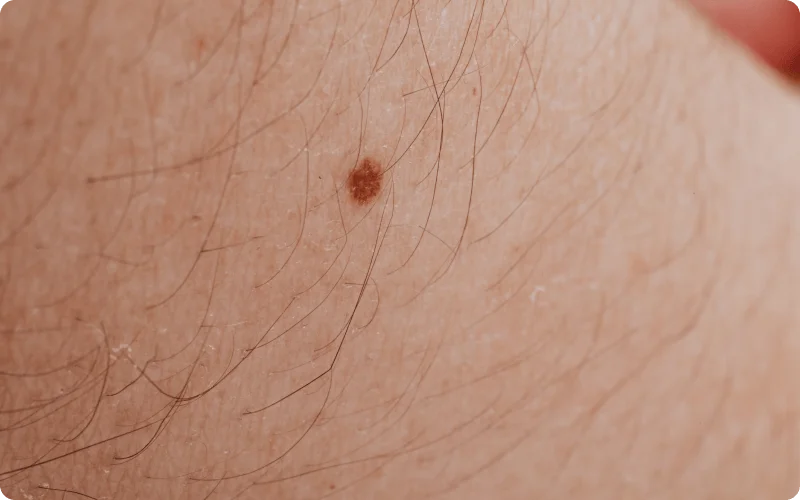 spot on skin - possible skin cancer?