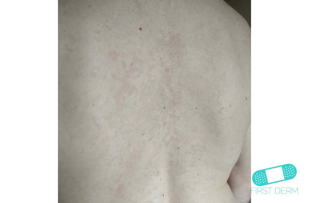 Vita prickar på huden Pityriasis versicolor (tinea verisicolor) (04) rygg [ICD-10 B36.0]