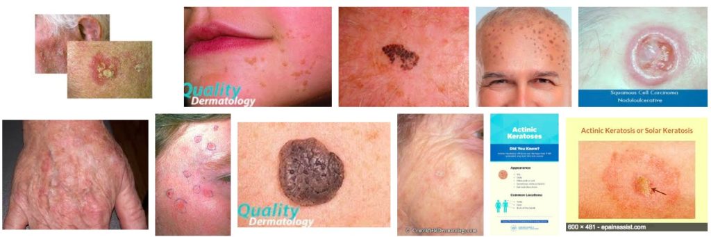 Skin Internet Search compared to Skin Image Search - Actinic Keratosis