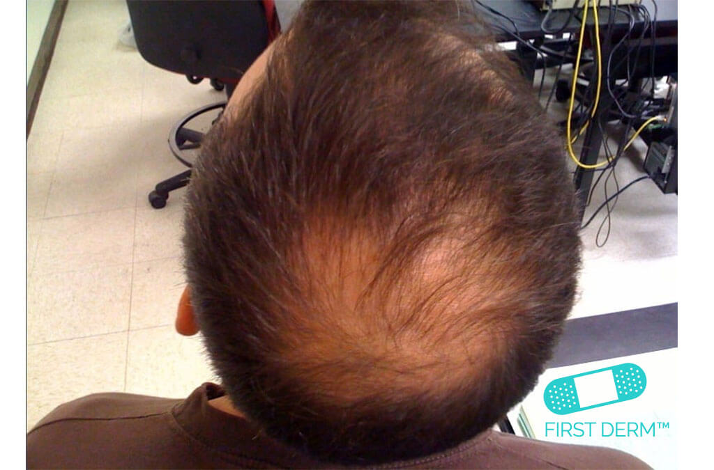 Male Hair loss also called alopecia areata ICD10 L65.8
