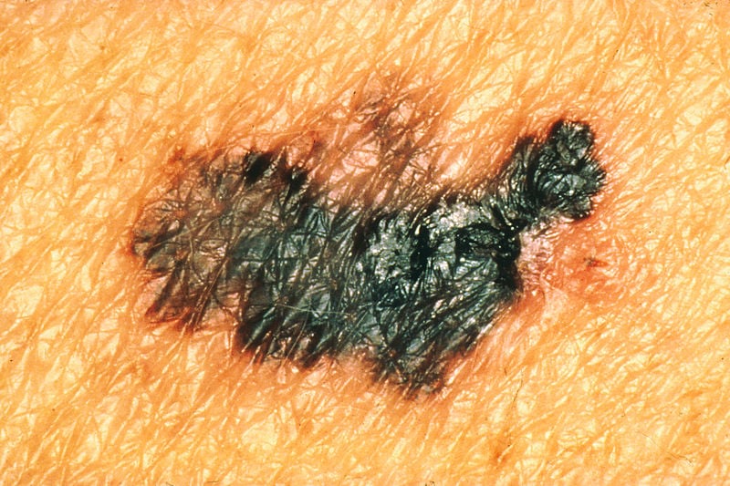 Can your phone diagnose melanoma?