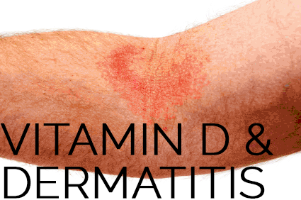 Daily dose of vitamin D combats seasonal atopic dermatitis