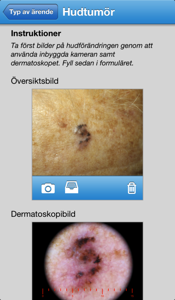 Teledermatology First-Derm-research-background Skin cancer pictures of malignant melanoma iDoc24