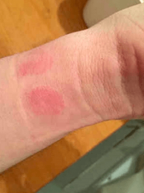 Apple Watch Rash and Your Skin – Allergy or Infection?