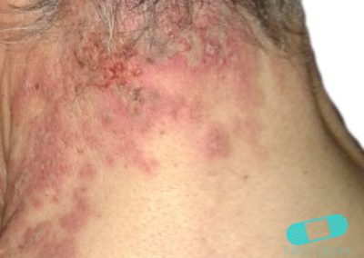 Herpes Zoster Shingles back (12) ICD-10-B02