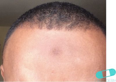 Hyperpigmentation fore head (5) ICD-10-L81.4
