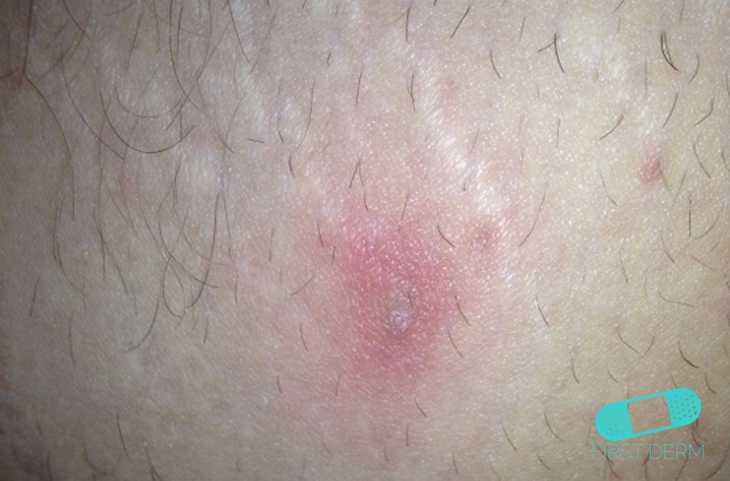  abscess on the waist, presenting as a swollen, reddish area with a distinct center but without visible pus