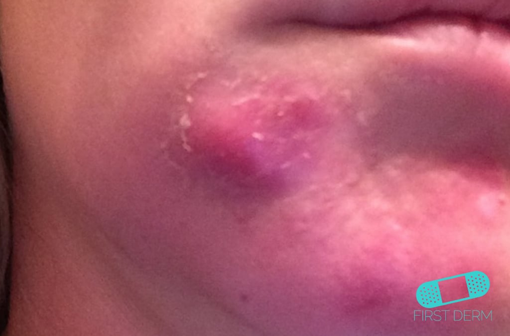 Cheek abscess on a person, identified under ICD-10 code L02.91. The abscess appears as a swollen, reddened area on the cheek