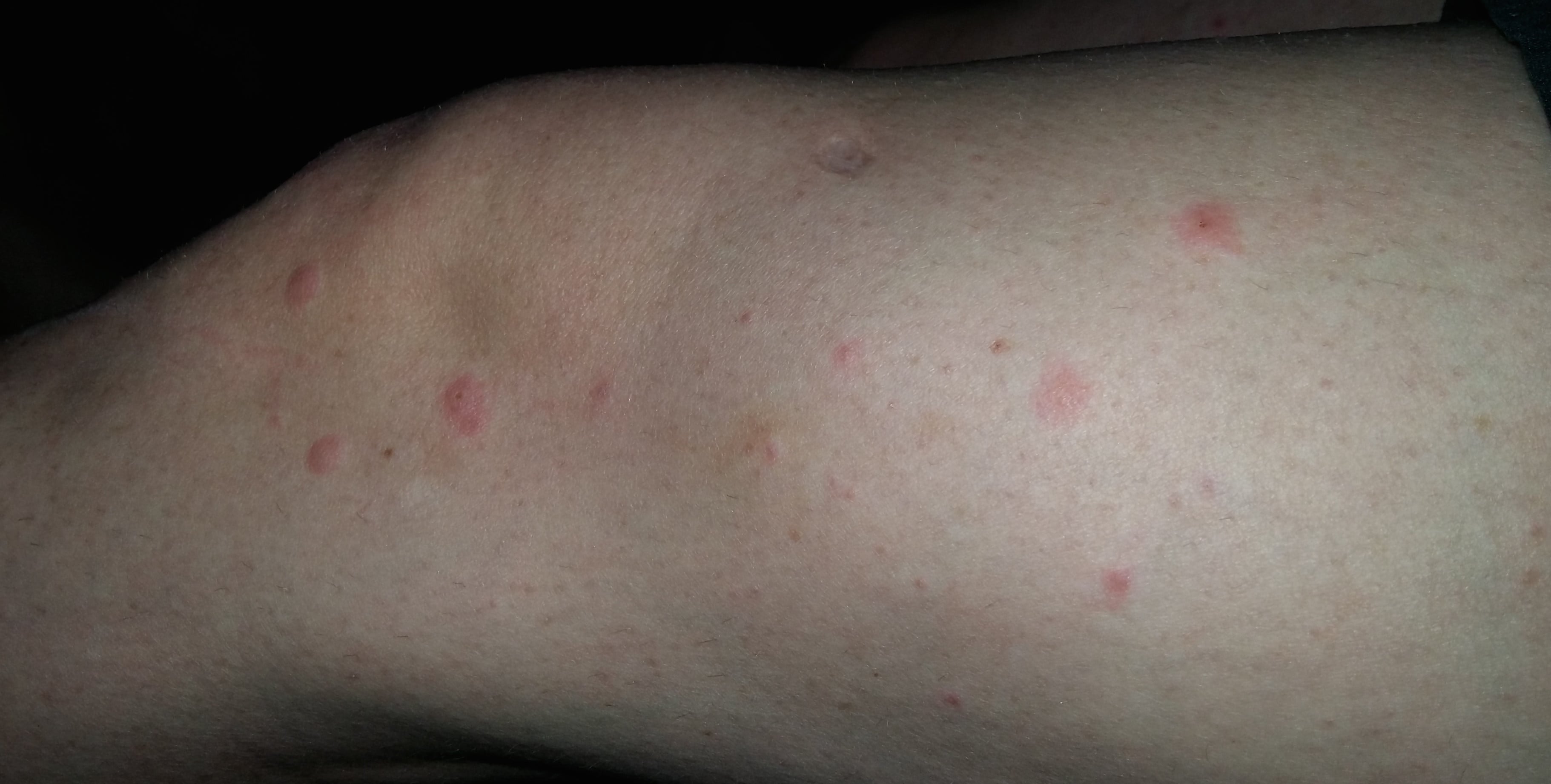 Close-up image showing what bed bug bites look like: itchy red bumps on a leg