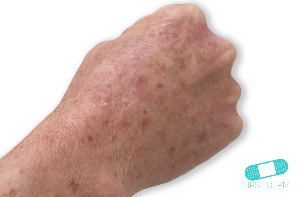 First Derm Actinic keratosis (2) ICD-10-L57.0