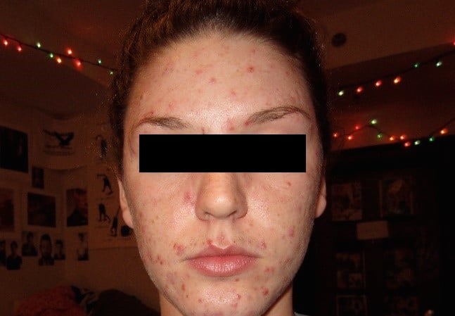 telemedicine jama study acne