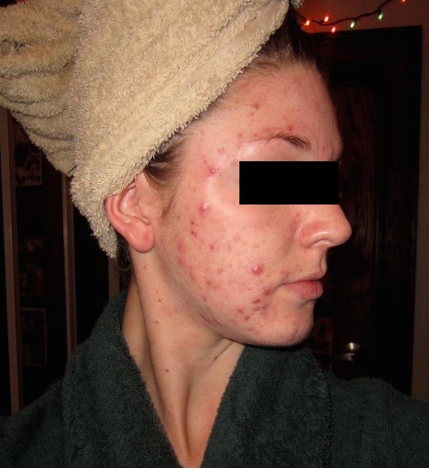 telemedicine jama study acne 2