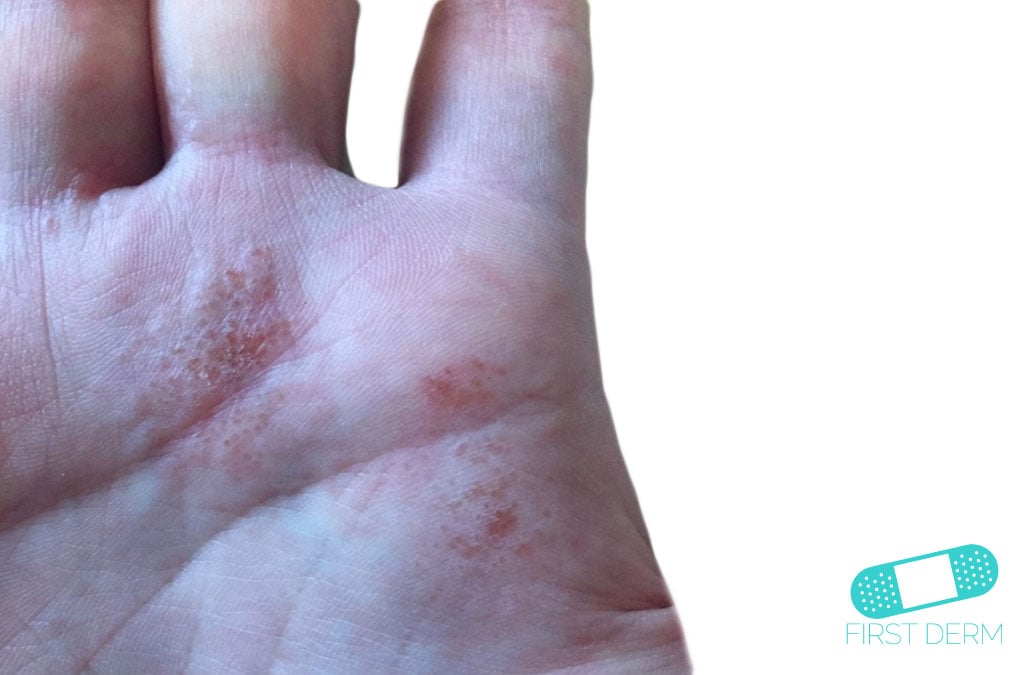 Hocket rash Dyshidrotic eczema (1) ICD-10-L30.1
