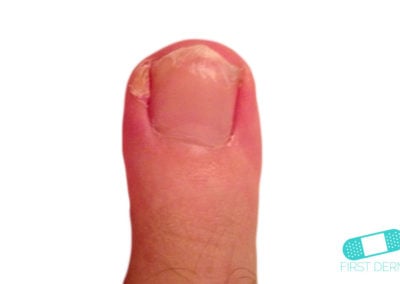 Hyperkeratos (1) finger ICD-10-A66.3