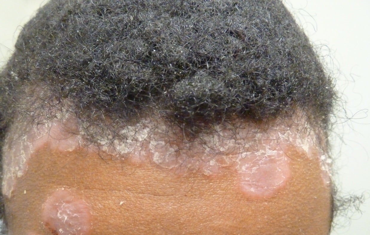 telemedicine jama study syphilis scalp