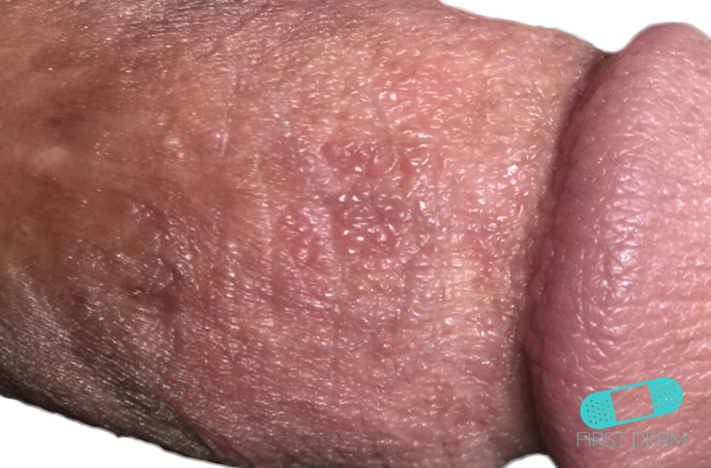 Mild balanitis symptoms on the shaft just below the head may include tiny raised spots, with minimal redness and swelling around the foreskin, indicating early inflammation