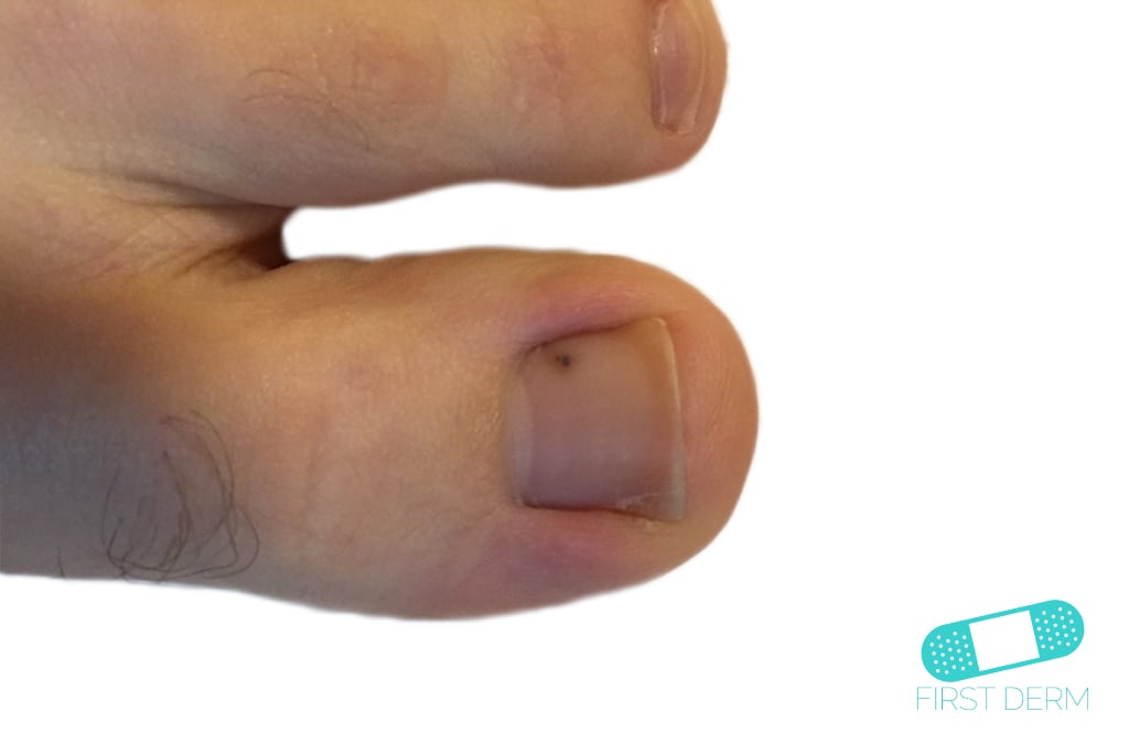 Melanoma big toe (7) ICD-10-C43.9