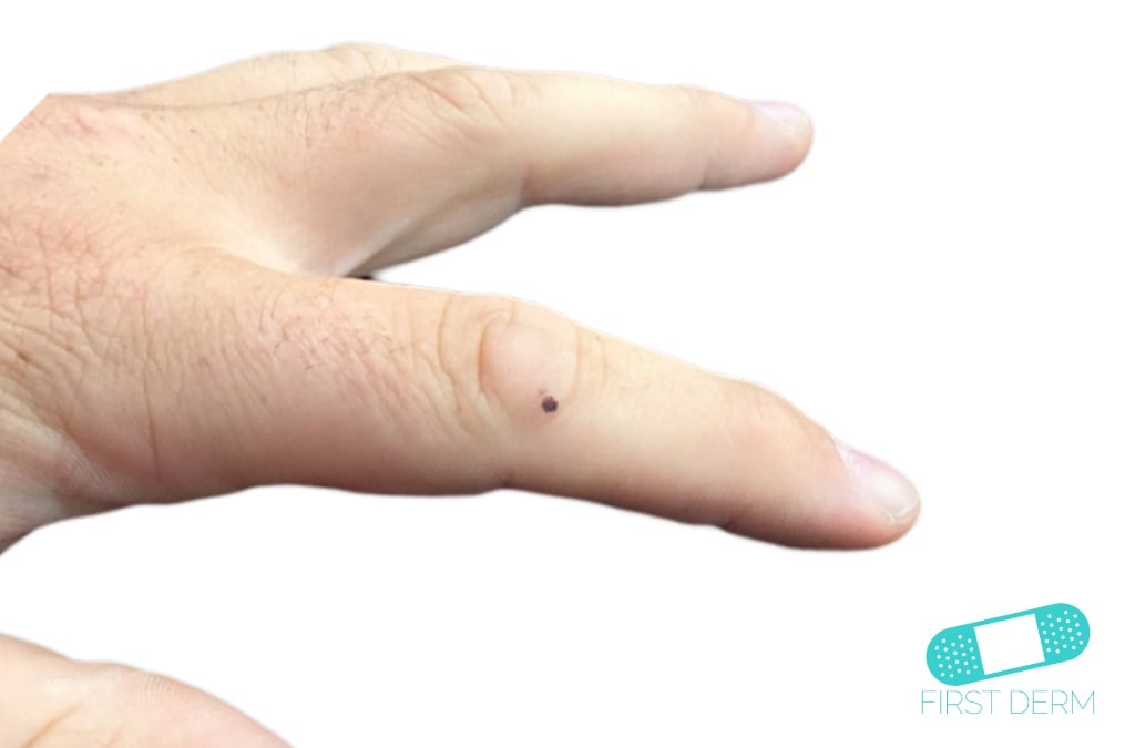 Melanoma Monday finger (9) ICD-10-C43.9