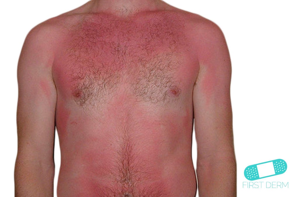 Sunburn and Sun Eczema