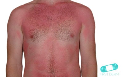 Sunburn and Sun Eczema
