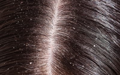 Hair Care: 5 ways to Deal with Dandruff