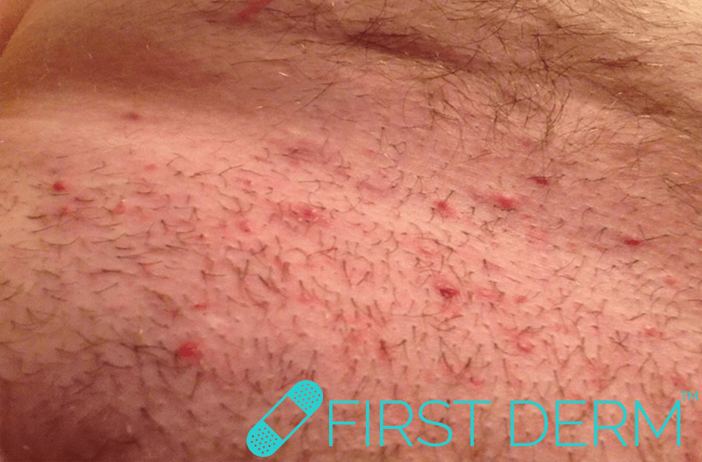 Friction burn from sex