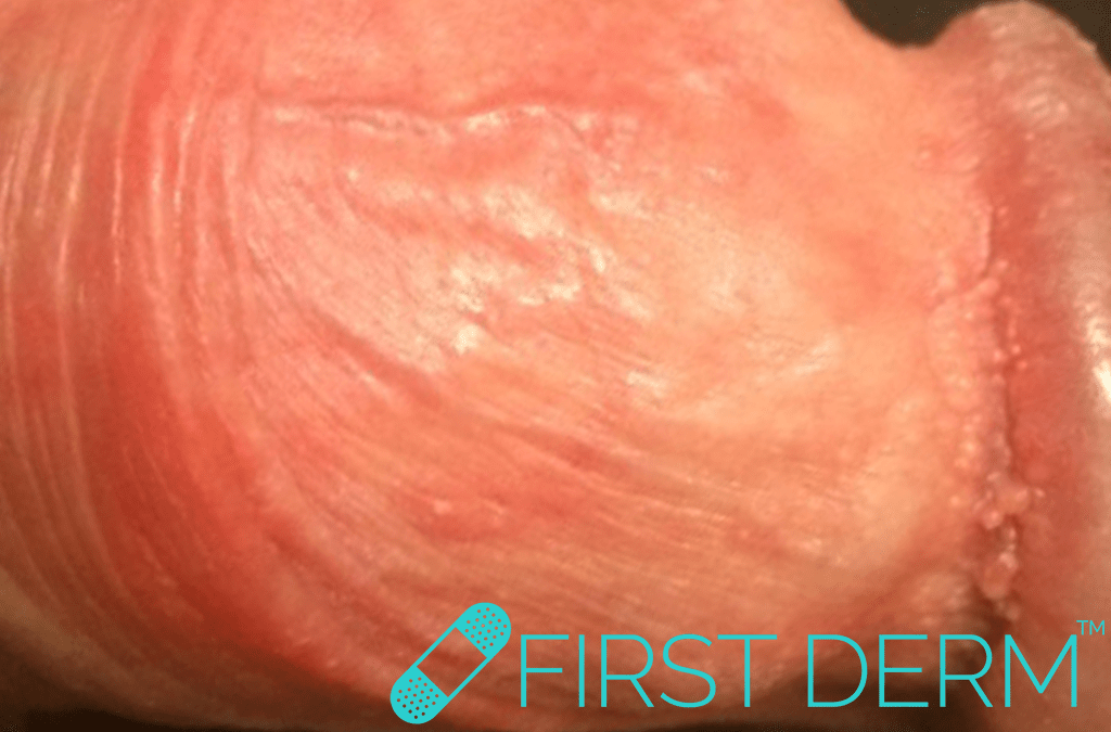  Pearly Penile Papules penis ICD 10 D29.0