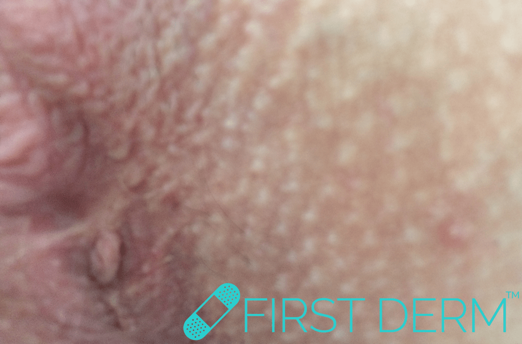 Sex rash Genital vagina Skin Tag Acrochordon ICD 10 Q82.8