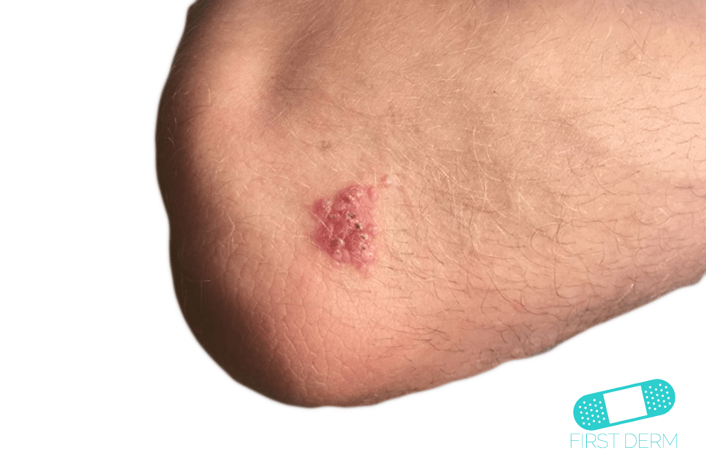 cutaneous leishmaniasis abroad summer vacation travel skin rashes ICD-10-B55.1