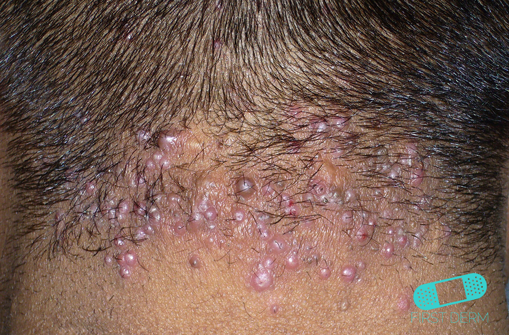 Black Skin Conditions and their treatment Acne Keloidalis Nuchae ICD-10-73.0
