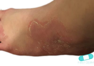 Tinea infections foot
