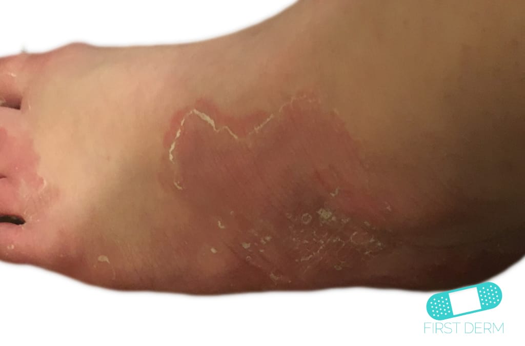 Hocket rash Tinea Pedia Athlete's Foot (1) ICD-10-B35.3